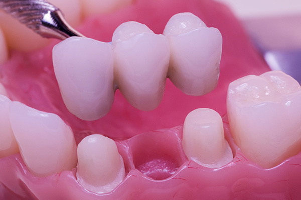 Dental Bridge FAQs