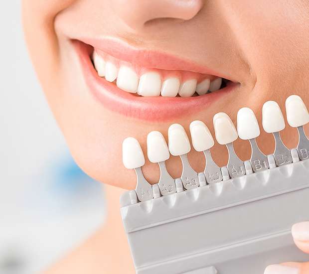 Costa Mesa Dental Veneers and Dental Laminates