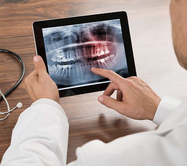 Costa Mesa Types of Dental Root Fractures