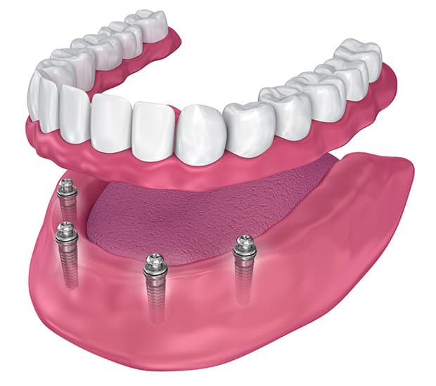 All-on-4 Implants Costa Mesa, CA