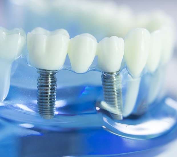 Dental Implants Costa Mesa, CA